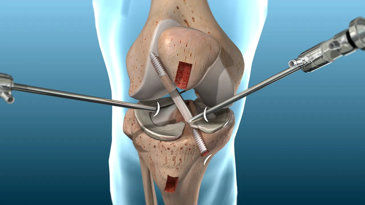 knee replacement surgery